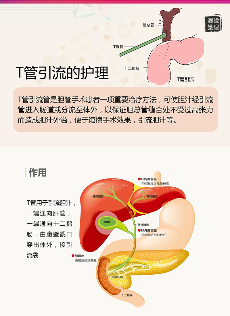 t管引流管的护理